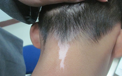 颈部白一块和周围的皮肤有明显区别怎么回事