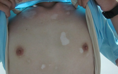 前胸和后背有一块淡白色斑点
