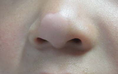 9岁女童鼻子上白斑发现一个月了