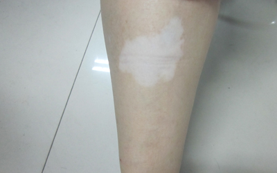 7岁女孩腿上有几处淡白色的白斑是什么
