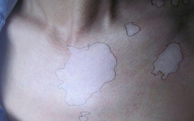 女性胸口和后背淡白色的斑点是什么