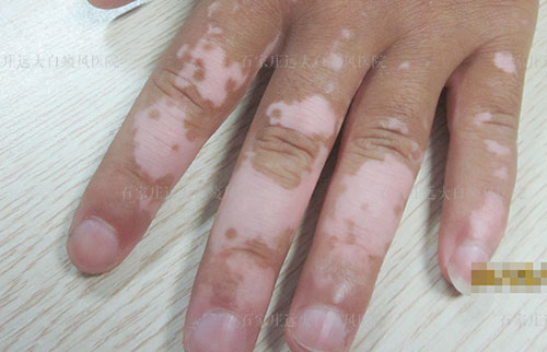 手指白癜风白斑初期的症状表现是什么
