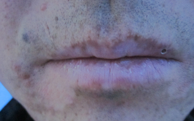 男性嘴部白癜风早期症状的图片