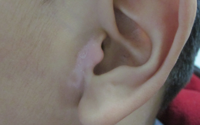 儿童耳部皮肤变白是什么原因