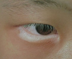 眼睛周围长白癜风会给患者带来哪些危害?