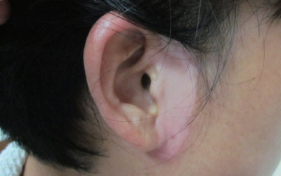 耳朵前边的白斑两个月了是什么