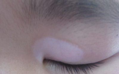 儿童眼角皮肤发白是什么症状
