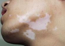 白癜风患者  为关心的几大问题