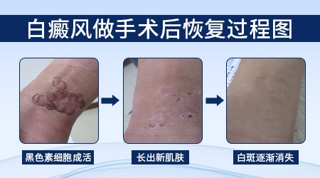 白癜风长在手上为什么恢复得慢
