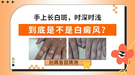 手上冒出来小白点会是白癜风吗