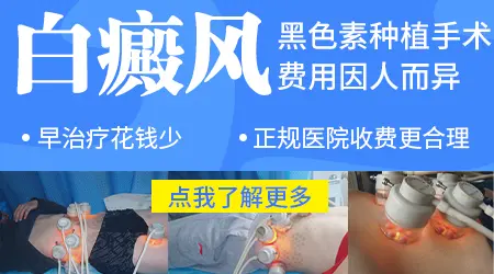 白癜风黑色素种植石家庄哪里做好