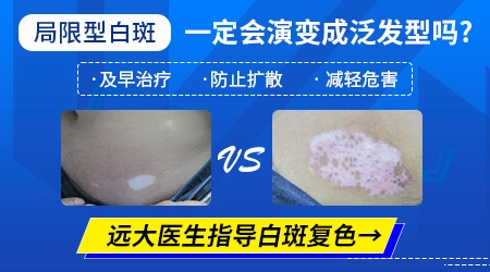 局限性不扩散的白癜风不管可以吗