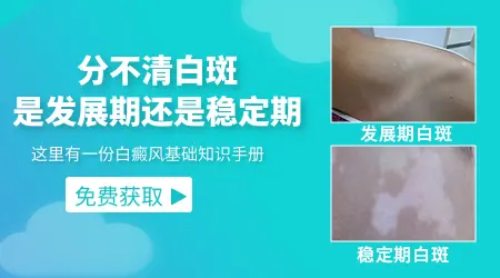 一小块白斑也没扩散是不是白癜风