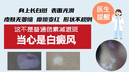 白斑摩擦后会发红是不是白癜风