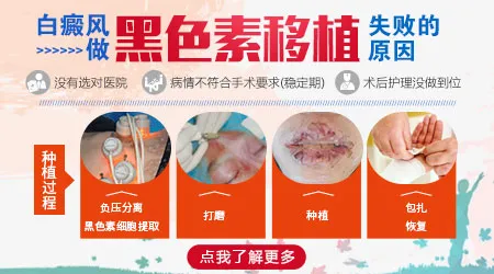 白癜风手术后多久不长黑色素岛算失败