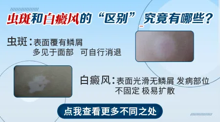 孩子脸上长白斑是白癜风还是虫斑？家长必看