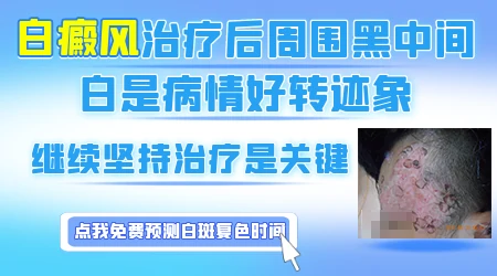 白癜风308光疗做多少次才会有效果