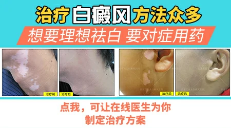 白癜风治疗3个月没好要不要换方案