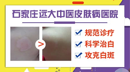 白斑和白癜风初发症状区别图