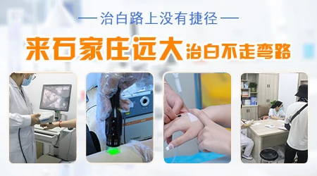 石家庄哪个医院看皮肤白斑好