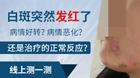 白癜风外用药膏使用后发红是正常反应还是过敏