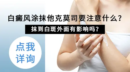 他克莫司软膏治疗白癜风到底有没有用