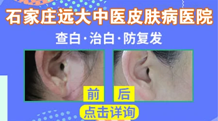 白癜风抗复发吃什么药好