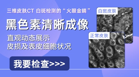 伍德灯下白癜风开始是什么样图片