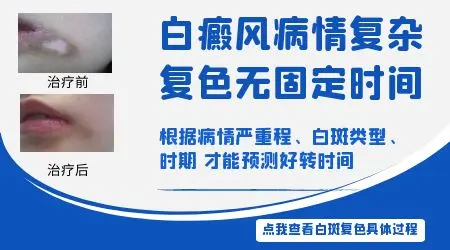 进展期白癜风先控制白斑需要多长时间