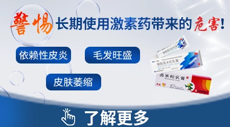 外用激素药治疗白斑有副作用吗