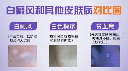 白癜风和其他白斑有什么区别图片对比