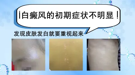 宝宝长白癜风最开始什么样图片