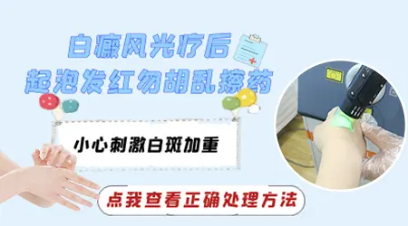 白癜风308激光照完之后皮肤发红起泡正常吗