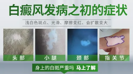 白癜风初期图片有哪些特殊表现