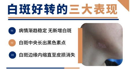 白斑打308激光好转会有什么表现