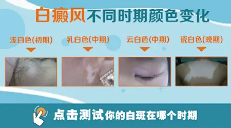 云白色的白斑是不是白癜风初期