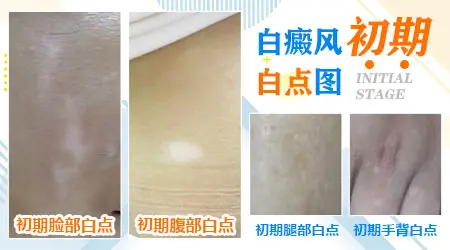白癜风初期白点有什么特征