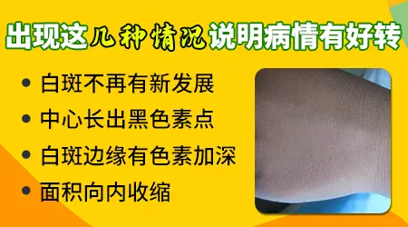 黏膜部位的白癜风能治好吗