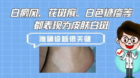 除了白癜风还有什么病会导致长白斑
