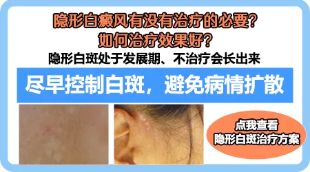 隐形白斑在伍德灯下什么样图片