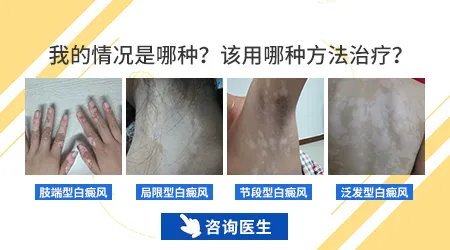肢端型白癜风用什么药效果明显