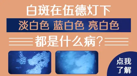 伍德灯下白癜风亮白色越明显病情越严重吗