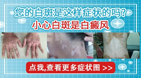 大腿上出现小白点会是白癜风的早期表现吗
