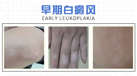 白癜风早期白斑是什么样的