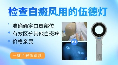 皮肤白斑伍德灯检查准确吗