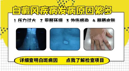 晕痣白癜风是什么原因引起的