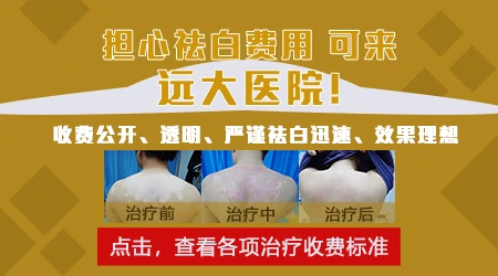 石家庄哪里能打白癜风复色针