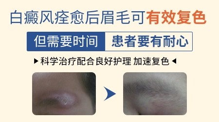 白癜风长在眉眼部位眉毛变白还能恢复吗