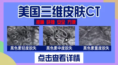 白癜风做皮肤CT检查有什么用 有必要做吗