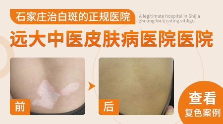 腋下汗斑和白癜风的区别图片对比